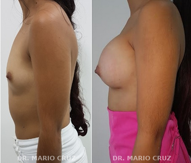 Dr Mario Cruz mamoplastiadeaumento2