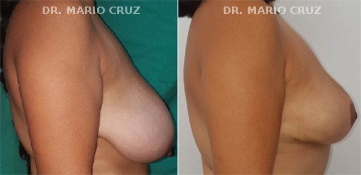 mamoplastiadereduccion.jpg